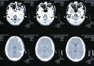 頭（脳）MRI画像